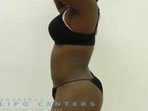 americanlipocenters_106.jpg